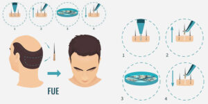 FUE Tekniği Nedir